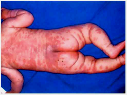 症状,反复高热,眼红,颈部淋巴结肿大,皮疹,口唇红,就要高度警惕川崎病