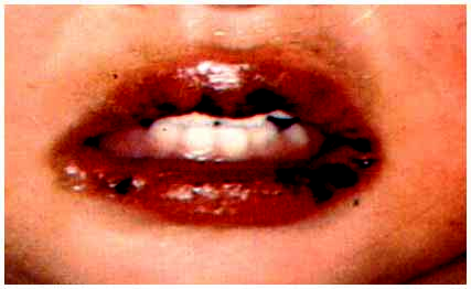 川崎病嘴唇照片图片