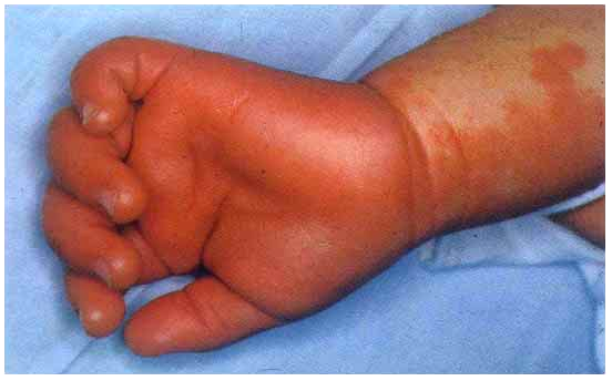 如何识别川崎病?