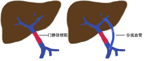 小儿肝外型门脉高压应首先选择rex手术治疗(图2),对于没有合适分流