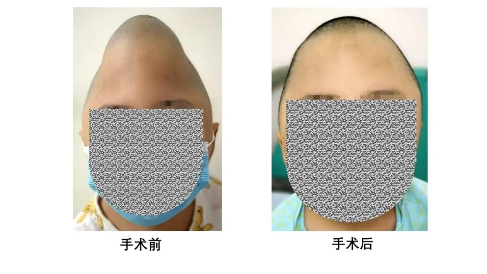 首儿所神经外科成功为奥特曼女孩进行颅骨外形重建手术